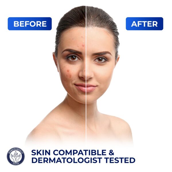 Advanced Azelaic Acid 15% Acne Cream   Redness Relief Rosacea Treatment for Face   Soothes Acne Hyperpigmentation   Enhanced Formula for Brighter Healthier Skin Care - Image 4